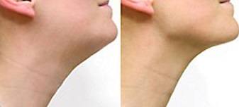 Masážní pomůcka na zmenšení podbradku Neckline Slimmer